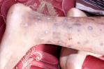 Haití advierte sobre una enfermedad altamente contagiosa, parecida a la sarna