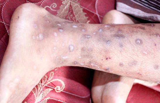 ¿En qué consiste la enfermedad contagiosa que afecta Haití? ¿En qué consiste la enfermedad contagiosa que afecta Haití?