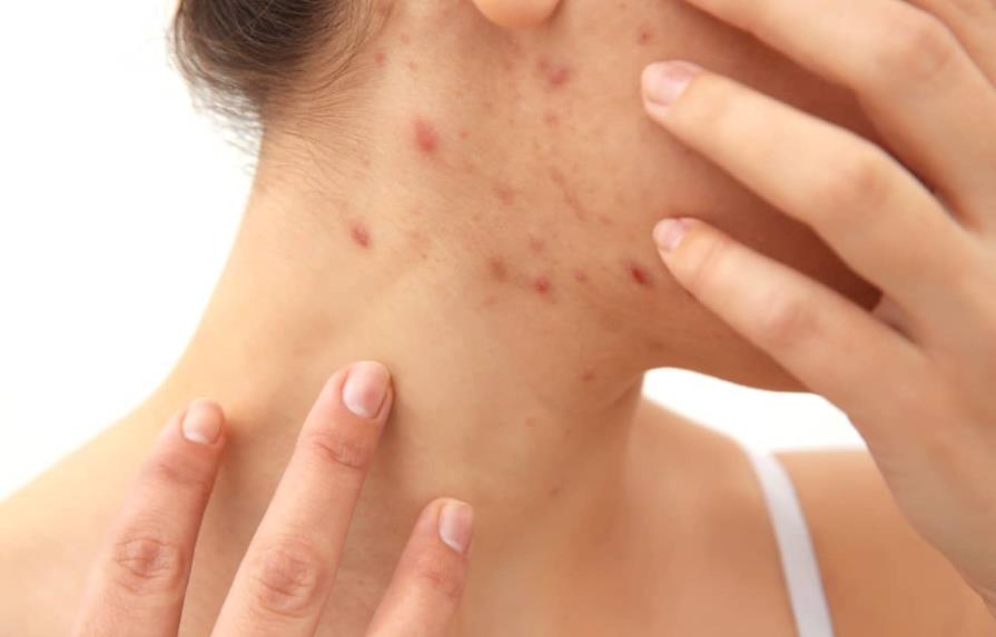 Sociedad Dominicana de Dermatología llama a no alarmarse ante enfermedad cutánea en Haití Sociedad Dominicana de Dermatología llama a no alarmarse ante enfermedad cutánea en Haití