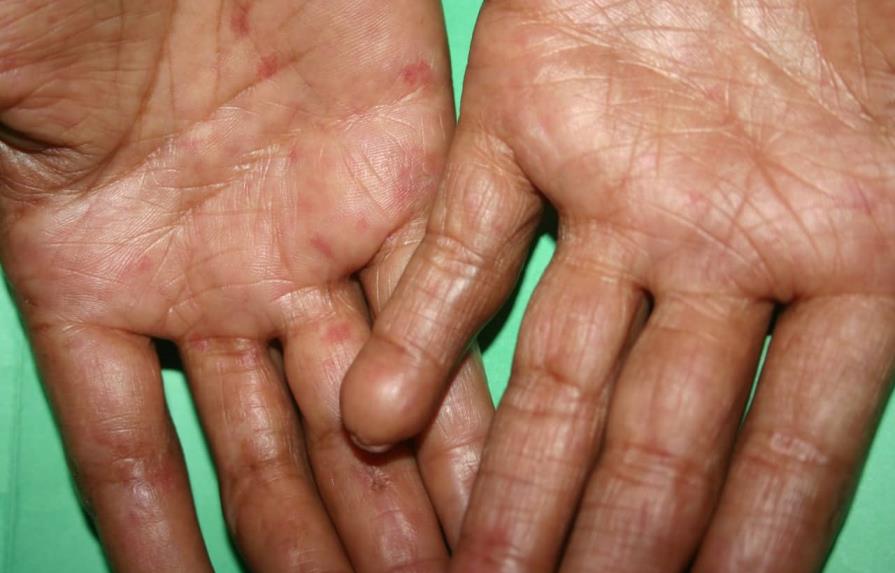 La sarna o escabiasis es una afección que tiene cura La sarna o escabiasis es una afección que tiene cura
