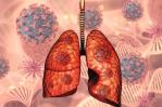 En el país se detectan 4,000 casos de tuberculosis cada año; el 23 % son VIH positivo