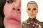 Khloé Kardashian muestra su cicatriz por cáncer de piel
