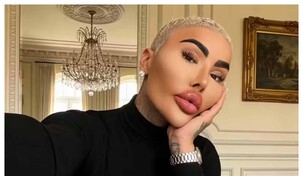 El rey de los labios, influencer que gastó miles de dólares en cirugías, muere por su obsesión