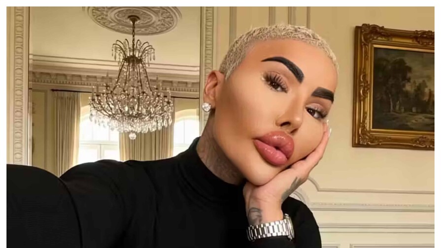 El rey de los labios, influencer que gastó miles de dólares en cirugías, muere por su obsesión