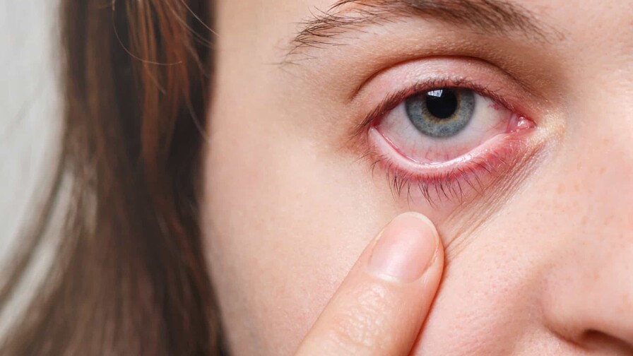 Aumentan los casos de conjuntivitis viral en las consultas oftalmológicas