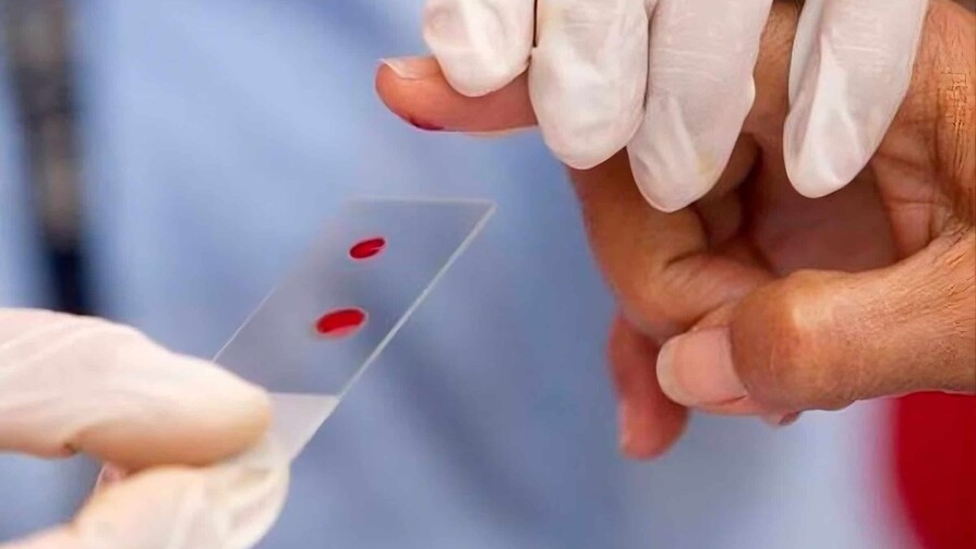 Estiman que más de 570 dominicanos viven con hemofilia