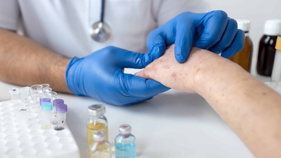 OPS advierte del aumento de casos de sarampión en las Américas