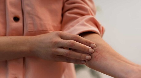 Dermatitis por calor: cómo reconocerla y prevenirla