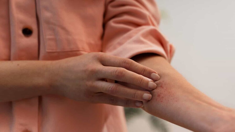 Dermatitis por calor: cómo reconocerla y prevenirla