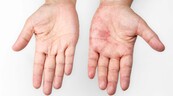 La ciencia descifra cómo se va extendiendo el herpes por la piel