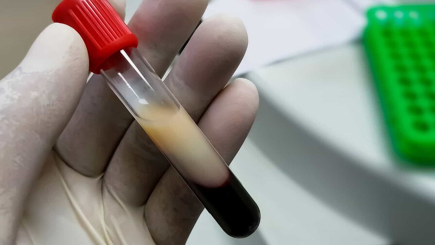 ¿Te suben los triglicéridos por la grasa que comes… o por el arroz, el pan y el jugo?