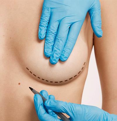 Explantación mamaria: por qué cada vez más mujeres deciden retirar sus implantes