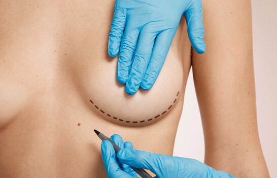 Explantación mamaria: por qué cada vez más mujeres deciden retirar sus implantes